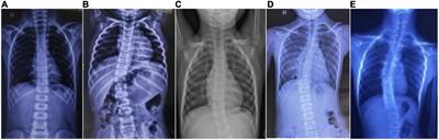 Clinical features and genotypes of six patients from four families with horizontal gaze palsy with progressive scoliosis